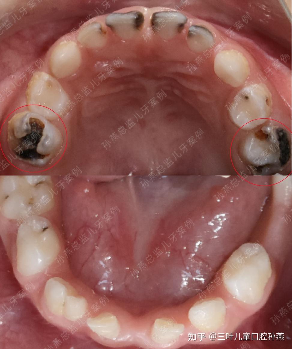 一年前家长就发现子轩牙齿变黑了,但因孩子害怕看牙不配合治疗,一直没