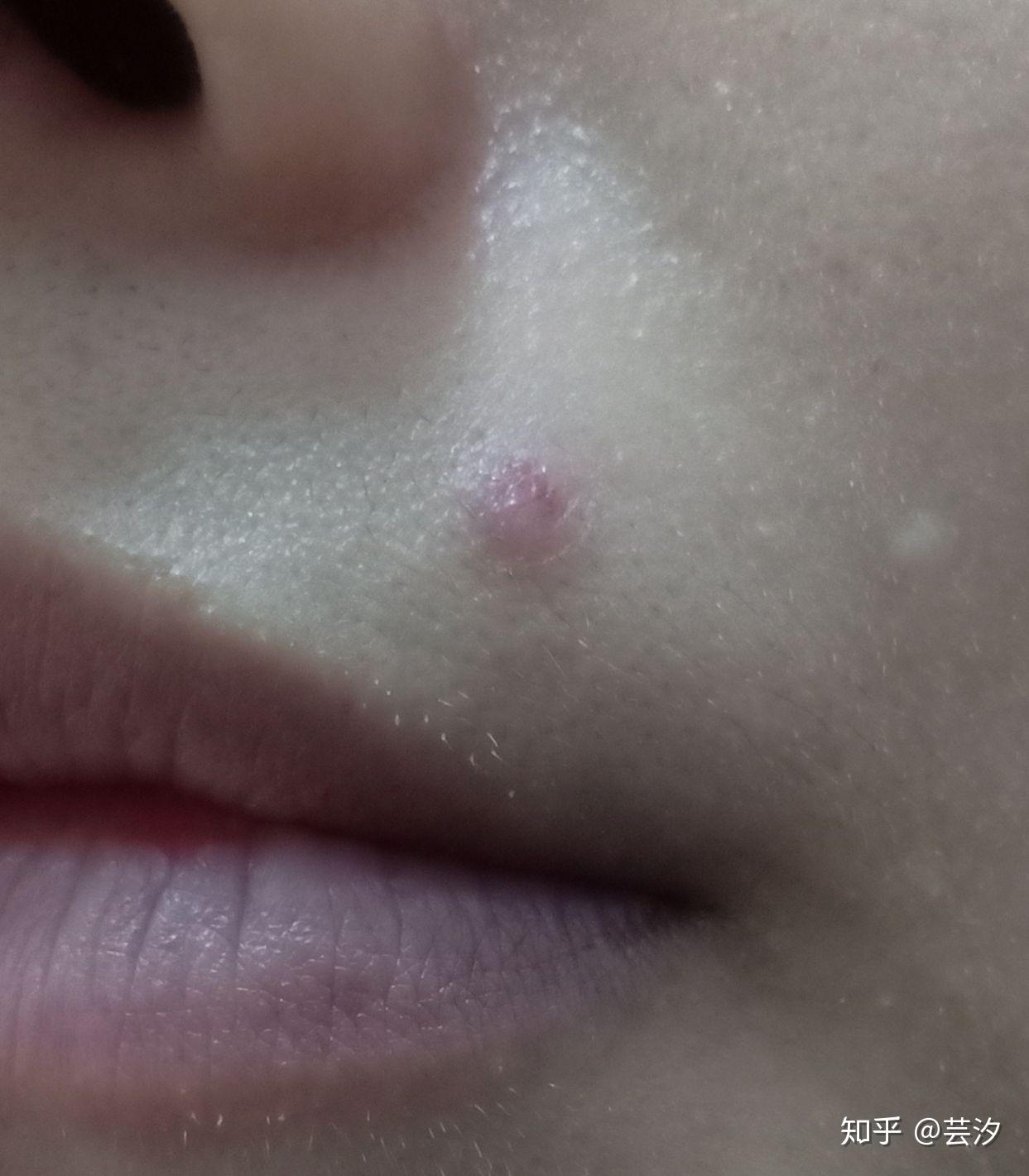 一个关于冷冻祛痣液氮的记录贴