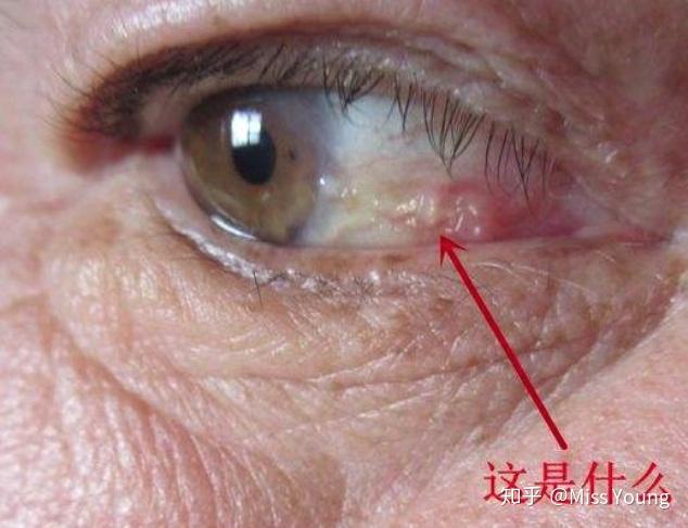 有什么方法让眼白白亮起来呢? - 知乎