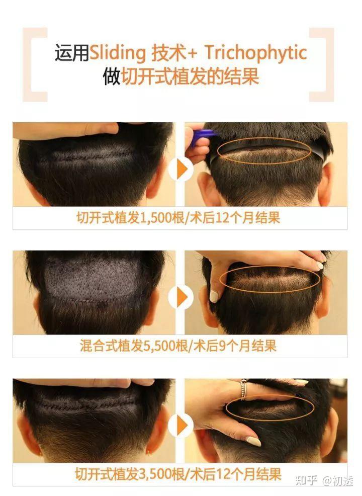 太原哪家植发最好(太原哪家植发医院正规便宜)