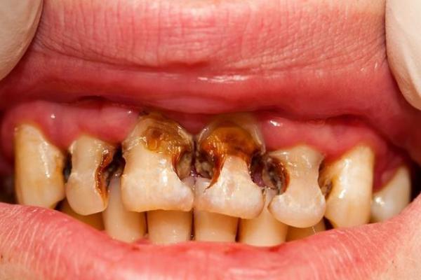 牙齿常见病症之龋齿