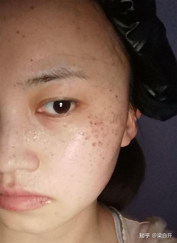 怀孕后第3个月脸上开始疯狂长妊娠斑,有什么效果好点的祛斑产品?