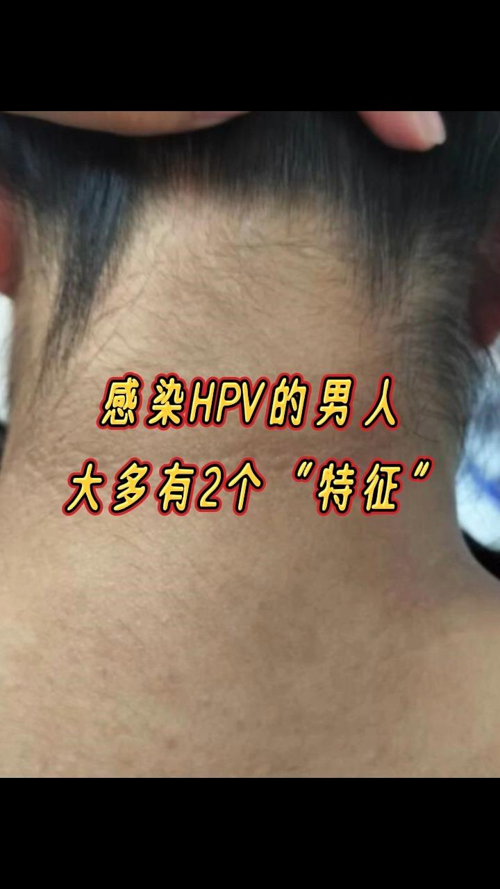 男性hpv有什么症状图片