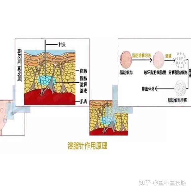 关于溶脂针的几个小知识
