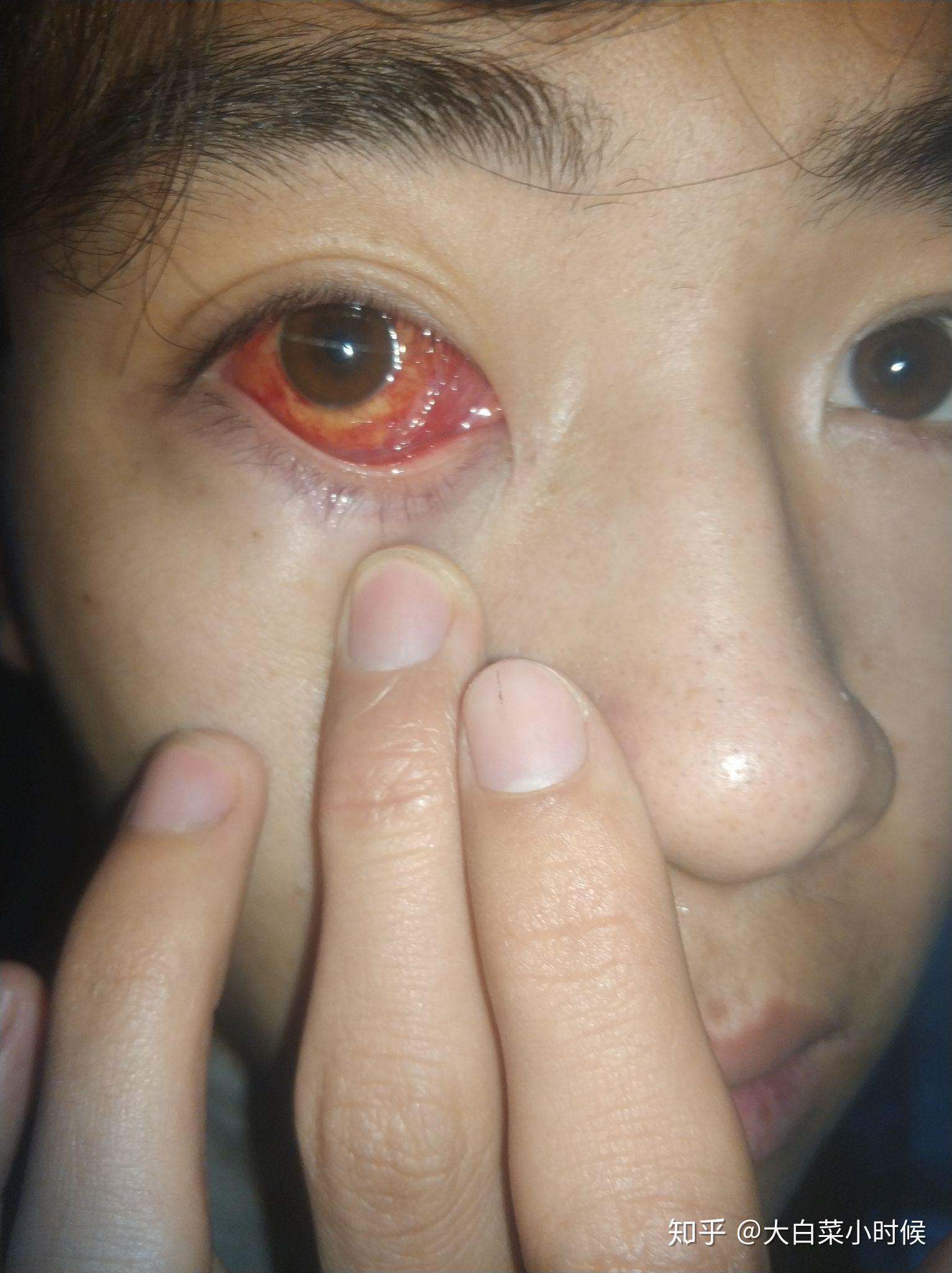 斜视手术是一种怎样的体验