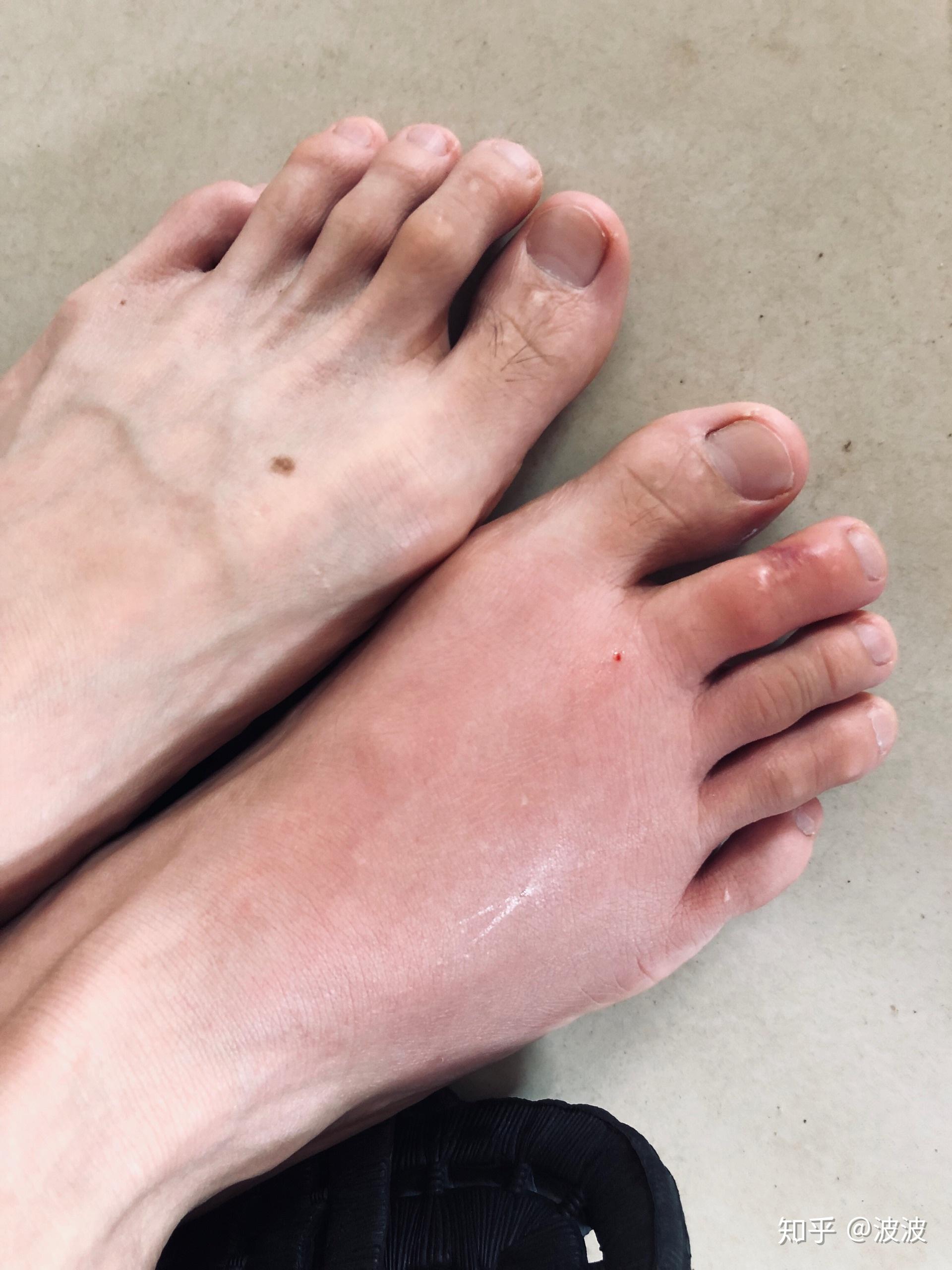 被蚂蚁咬了抠破一次然后现在又红眼痒又肿该怎么处理