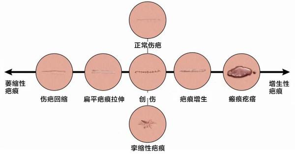 最新的皮肤疤痕分类,评估和治疗方法 - 知乎