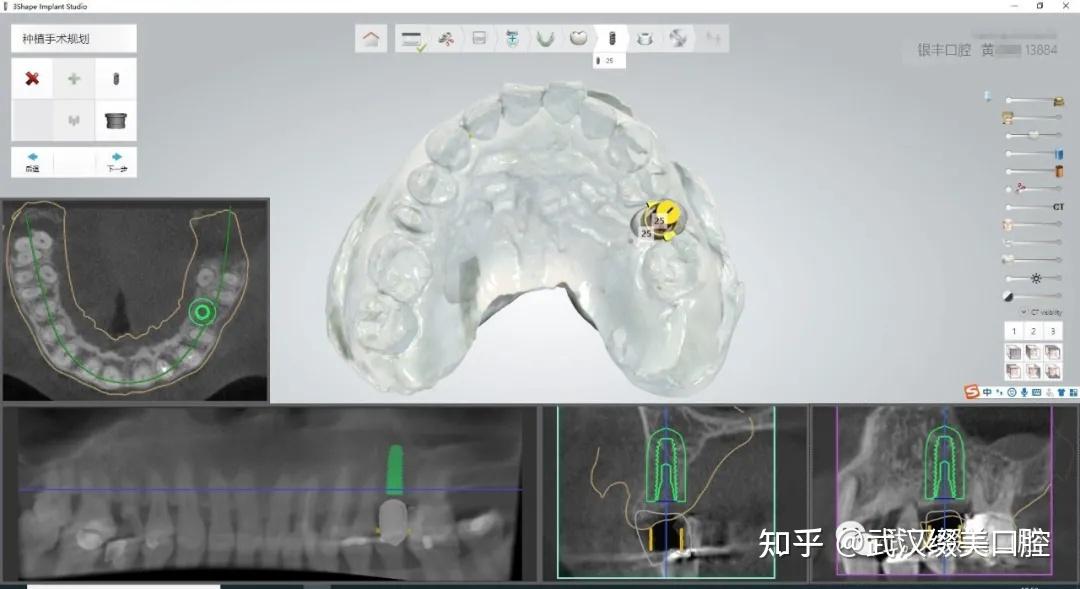武汉缀美口腔数字化种植导板新技术让种植牙多一重保障