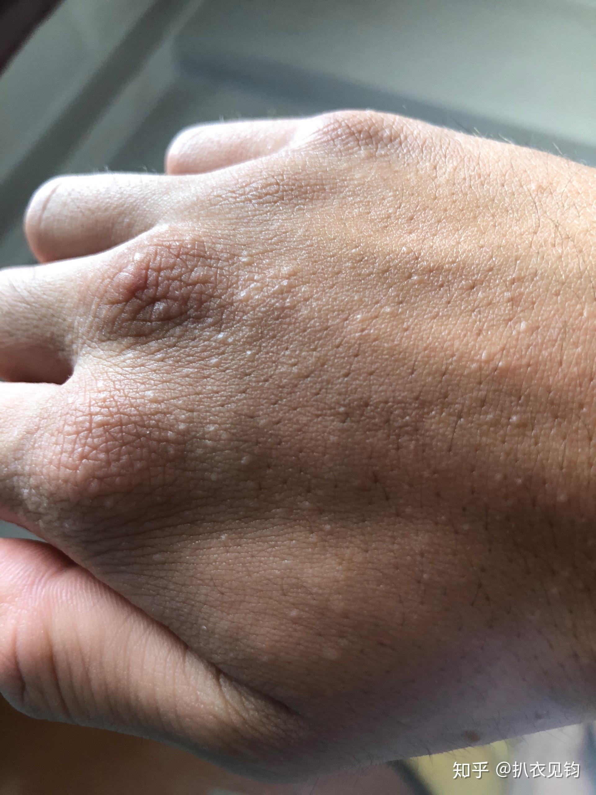 手面上长的好几个小疙瘩,十多年了.以前没什么感觉最近感觉有点痒.