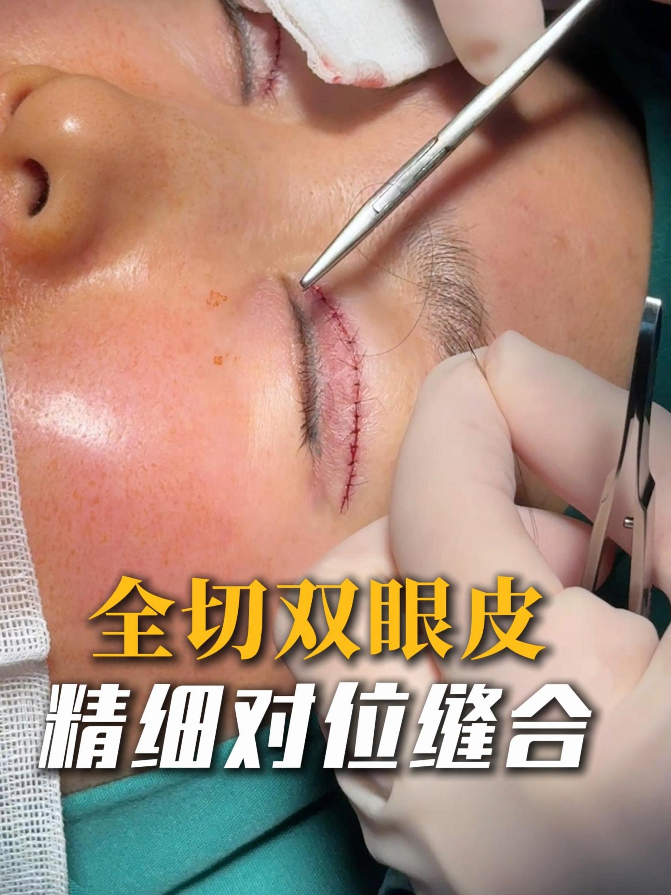 全切双眼皮精细对位缝合