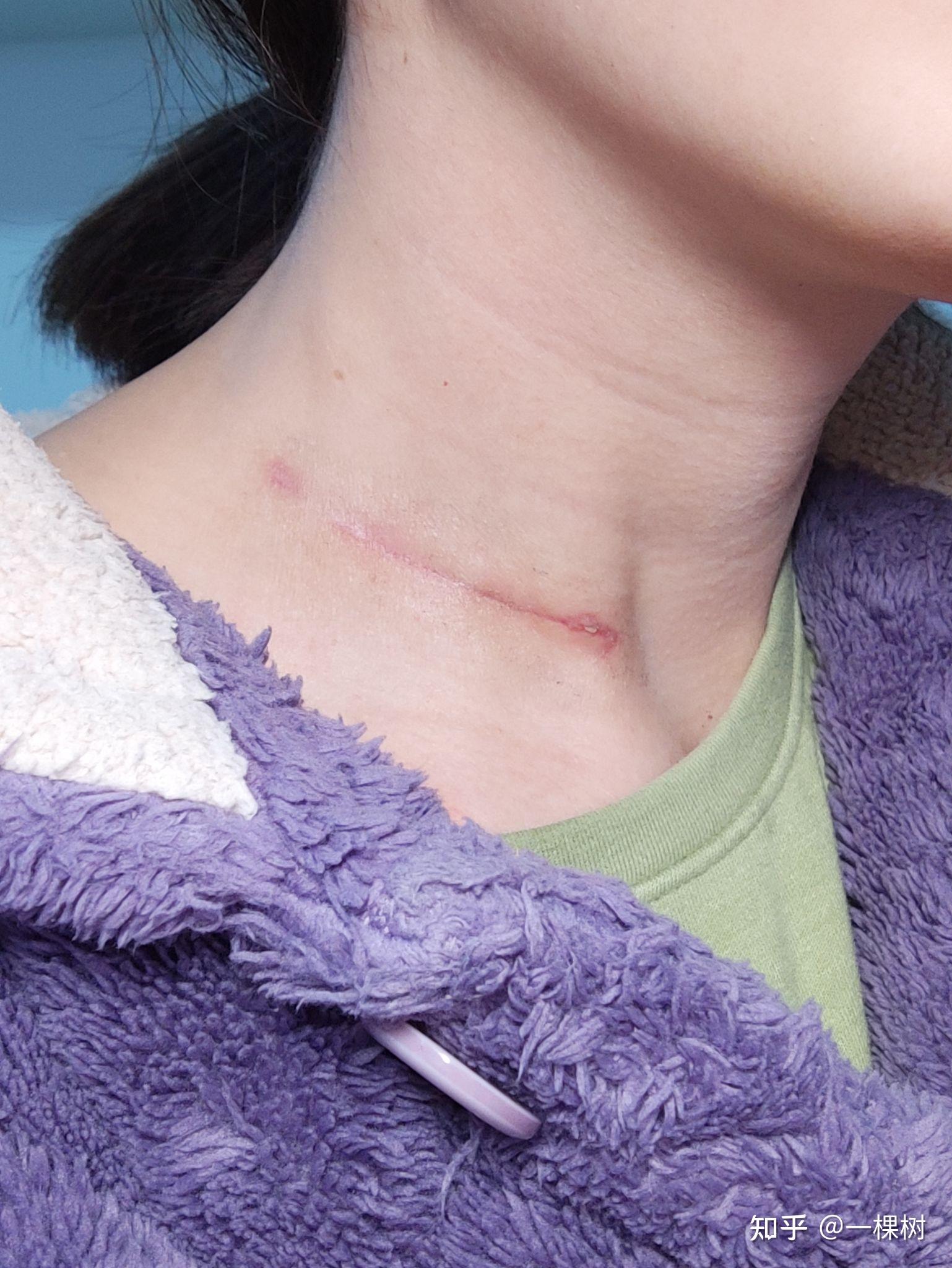 记录我的甲状腺手术伤口恢复历程