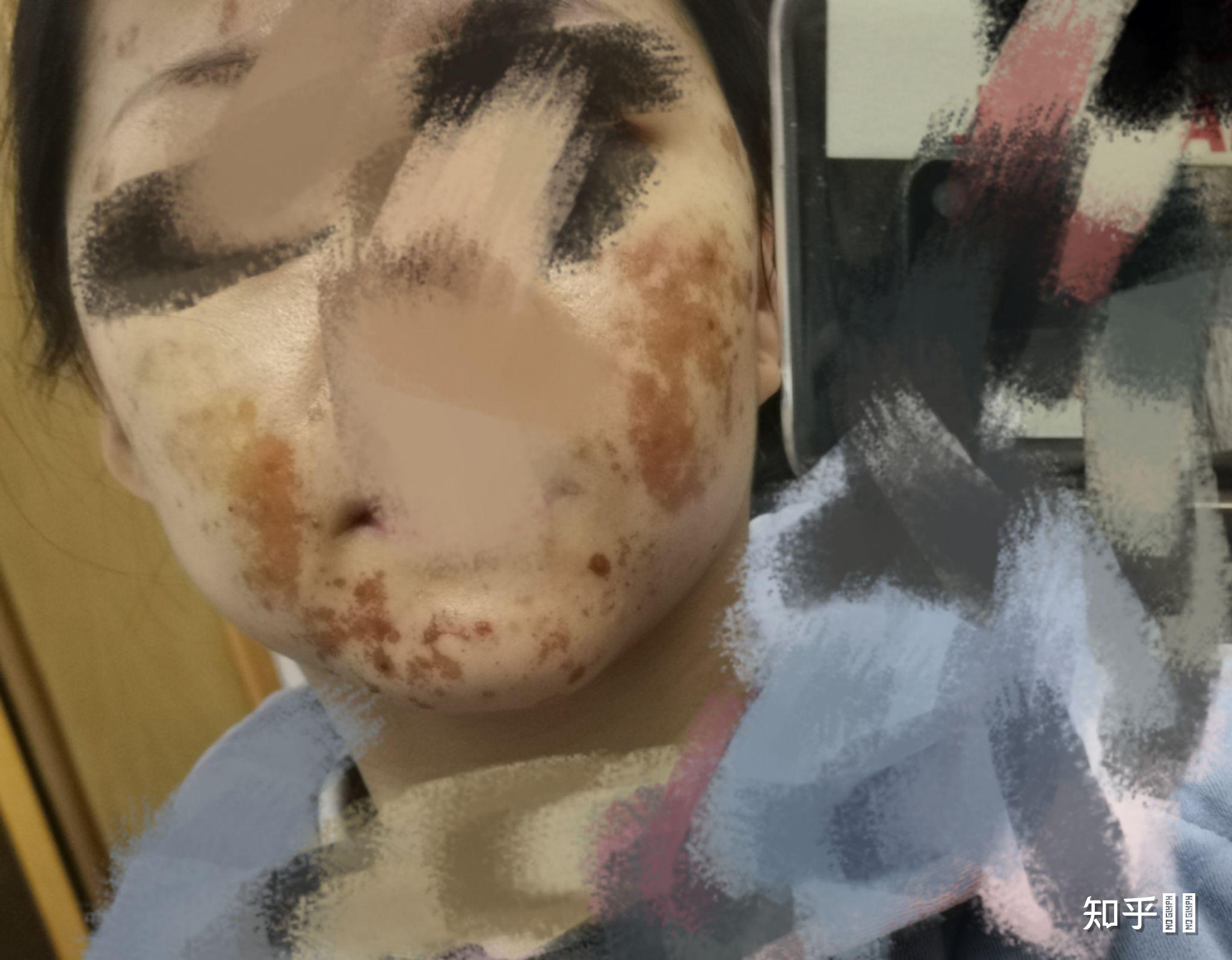 果酸灼伤是什么体验?