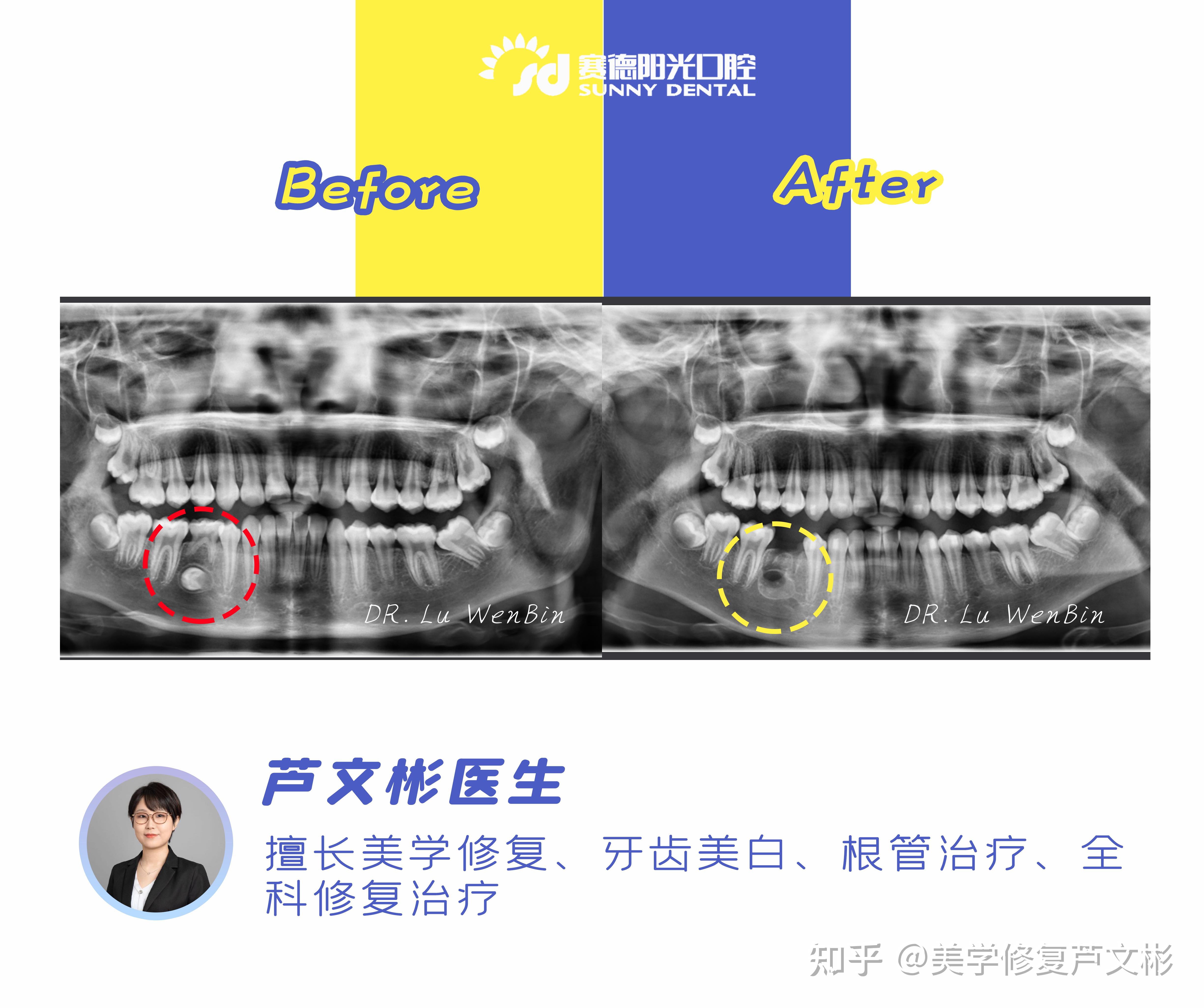 【博康泰】前牙美学树脂修复课程— —4月16日-17日 ，口腔培训，康强培训网