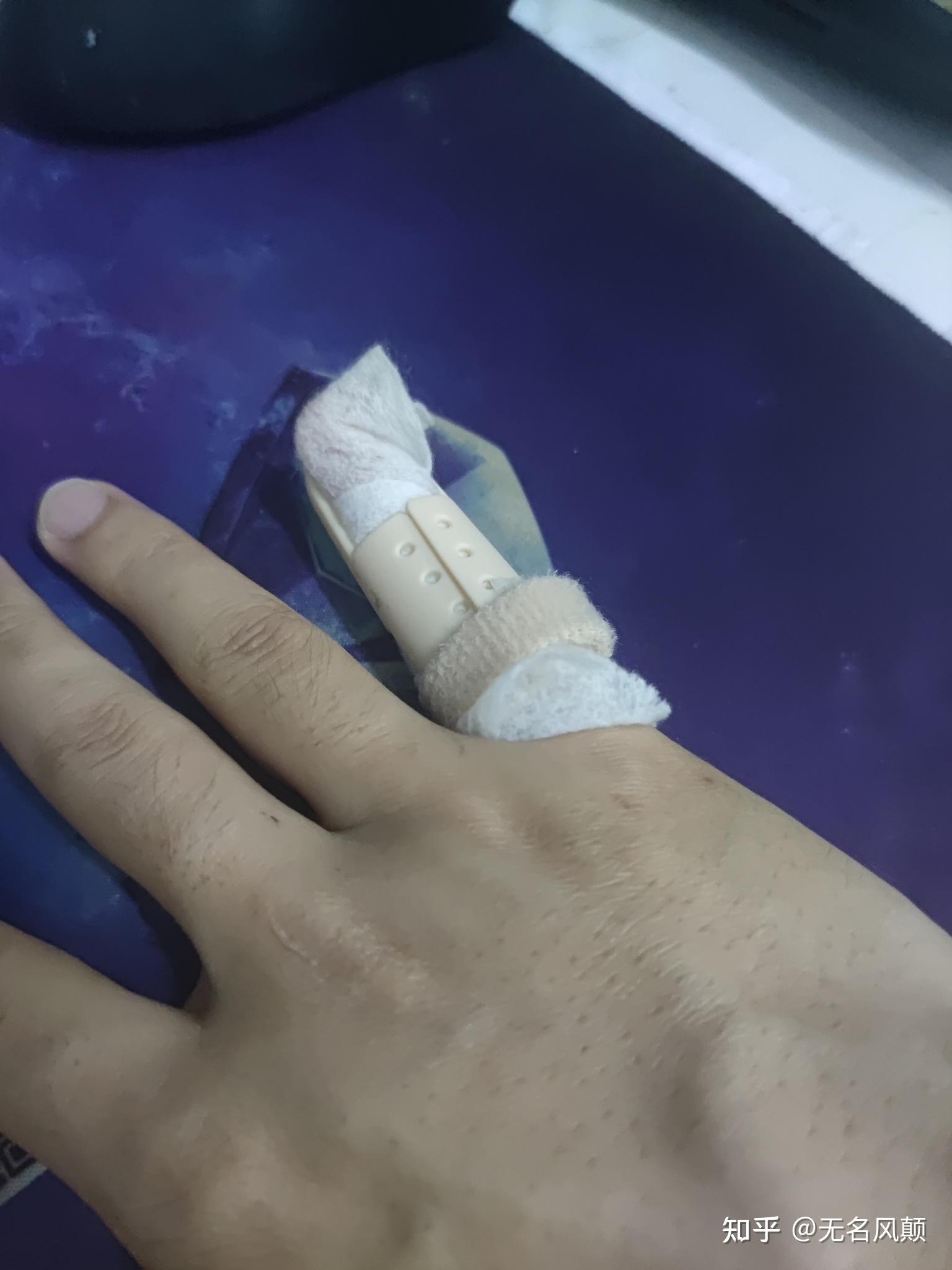 打篮球时手指戳伤不能伸直求有经验的大神告诉我这是否严重啊