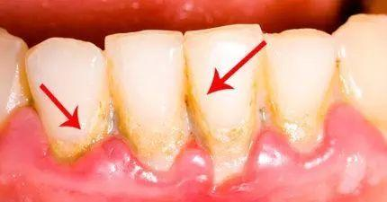 牙松动牙缝大真的不是洗牙的错