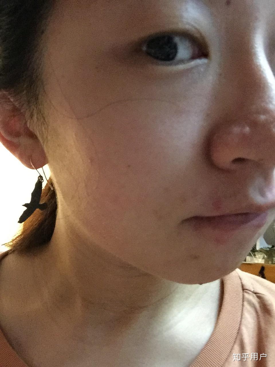 鼻子上的痘痘掉了之后鼻子变的凹凸不平怎么办