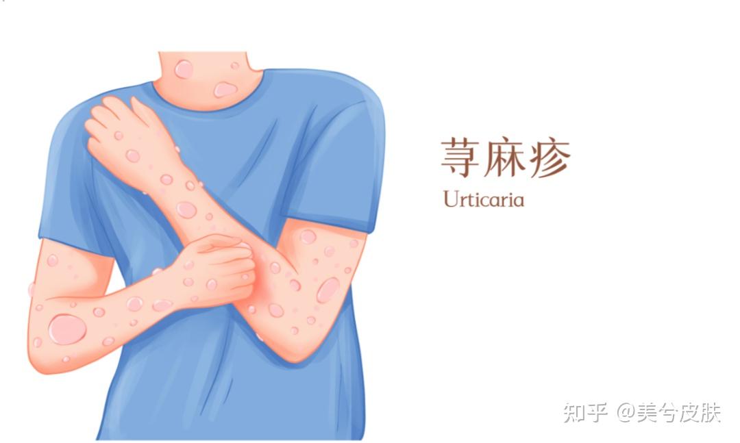 痒痒痒痒！荨麻疹反反复复发作，谁能救救我！ - 知乎