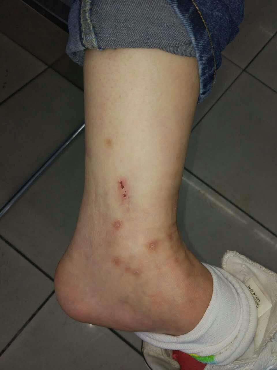 被老鼠身上的跳蚤咬了会得鼠疫吗