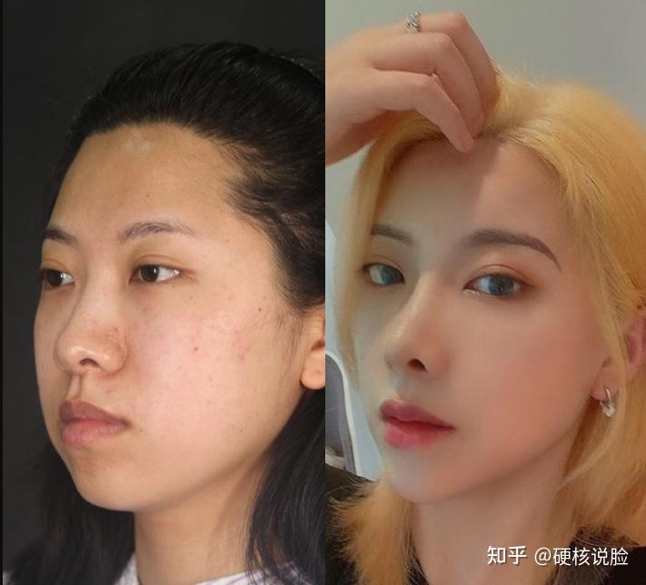 整容逐渐成为趋势,野生整容案例分享 - 知乎