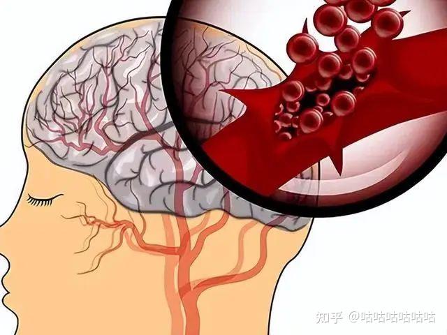 腦梗到底是什麼什麼樣的症狀就是腦梗了呢