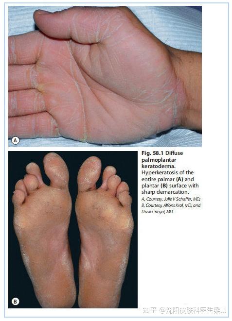 者仅有掌跖皮肤粗糙,严重时掌跖出现弥漫性斑块状,边缘清晰的角质增厚