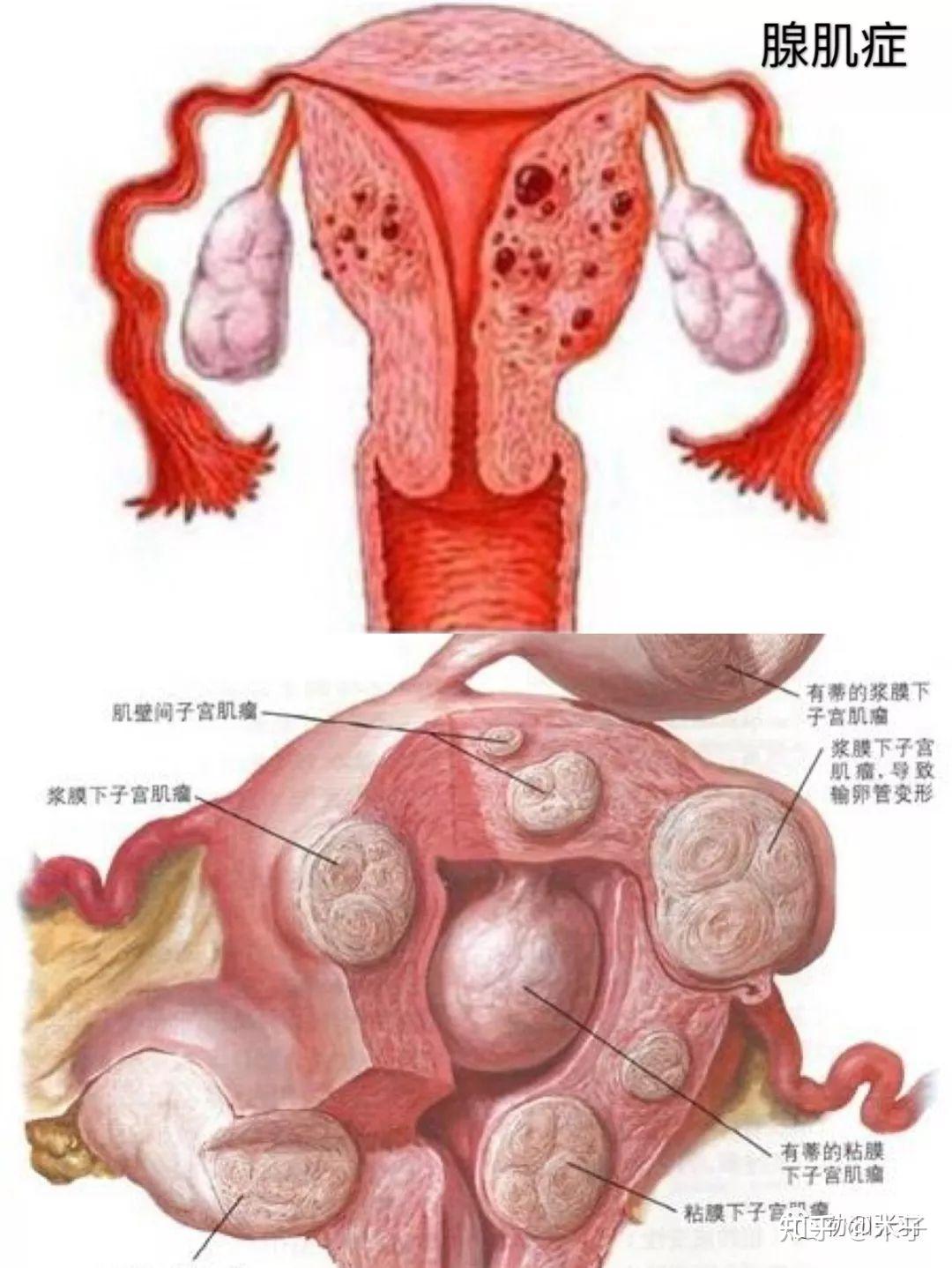 子宫内膜肌瘤 知乎