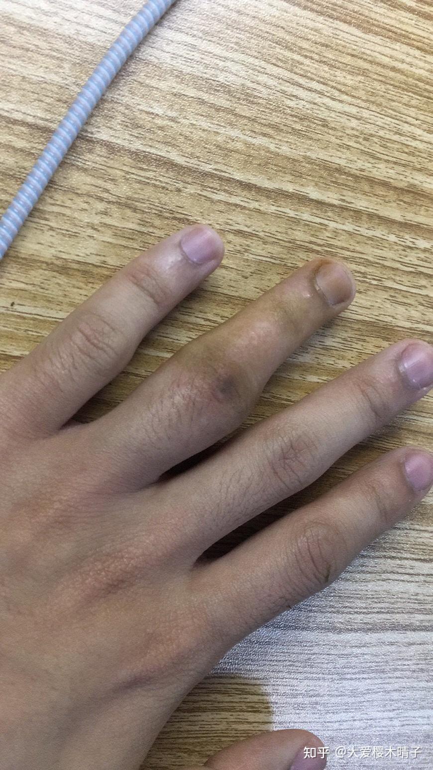 打篮球手指脱臼处理?