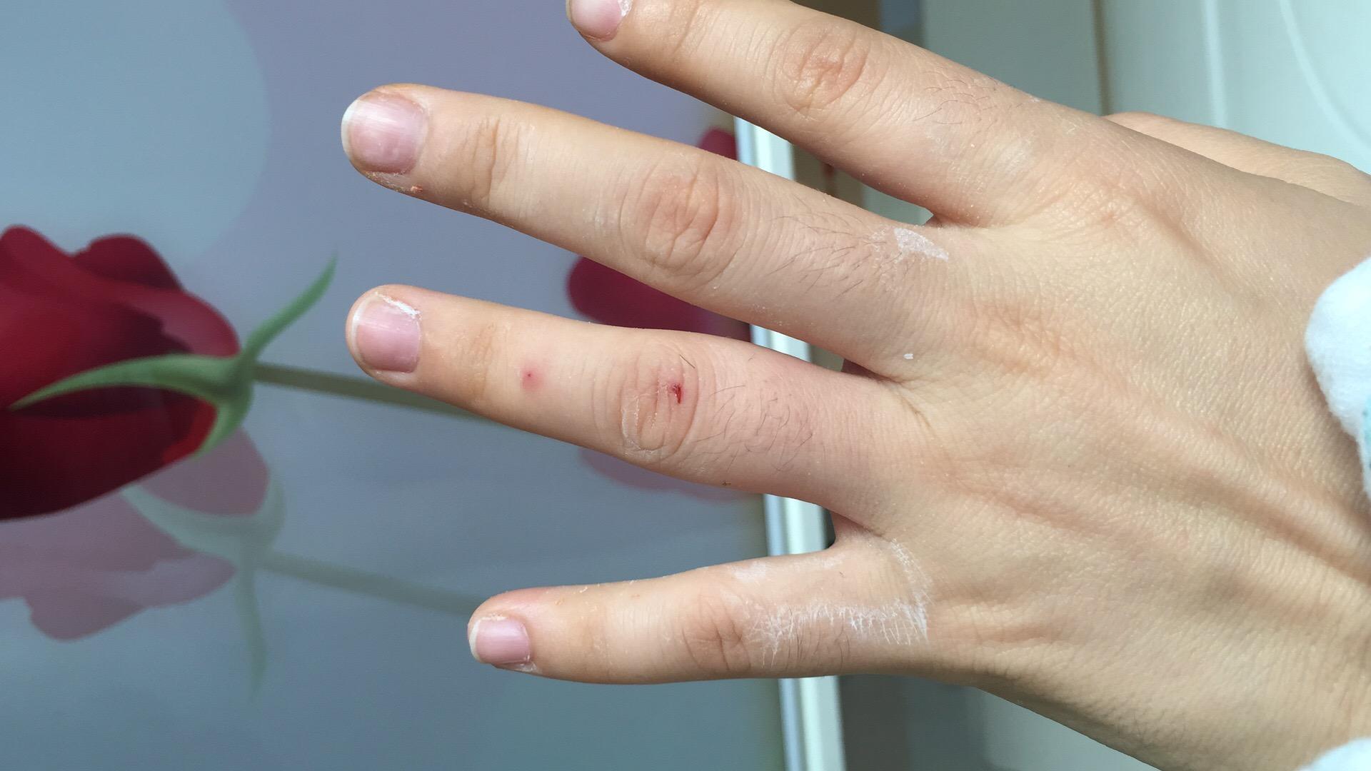 被蝎子蛰一下是什么体验? - 知乎