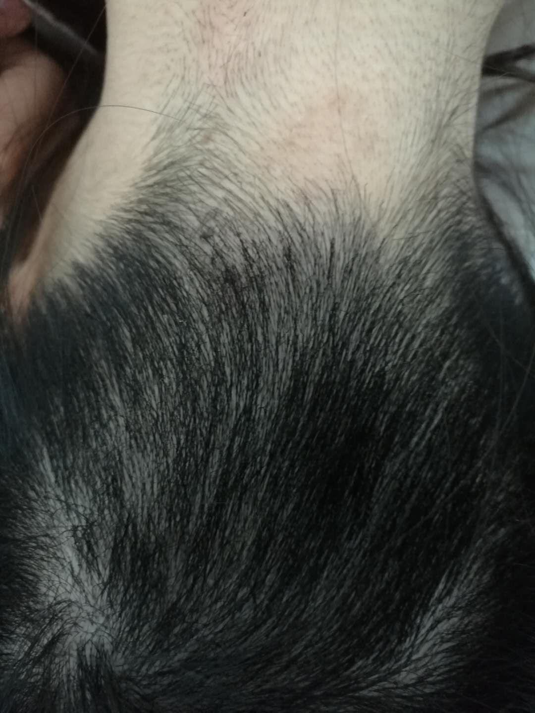 请问头部脂溢性皮炎产生的大块白色片状鳞片到底是什么物质以及诸多