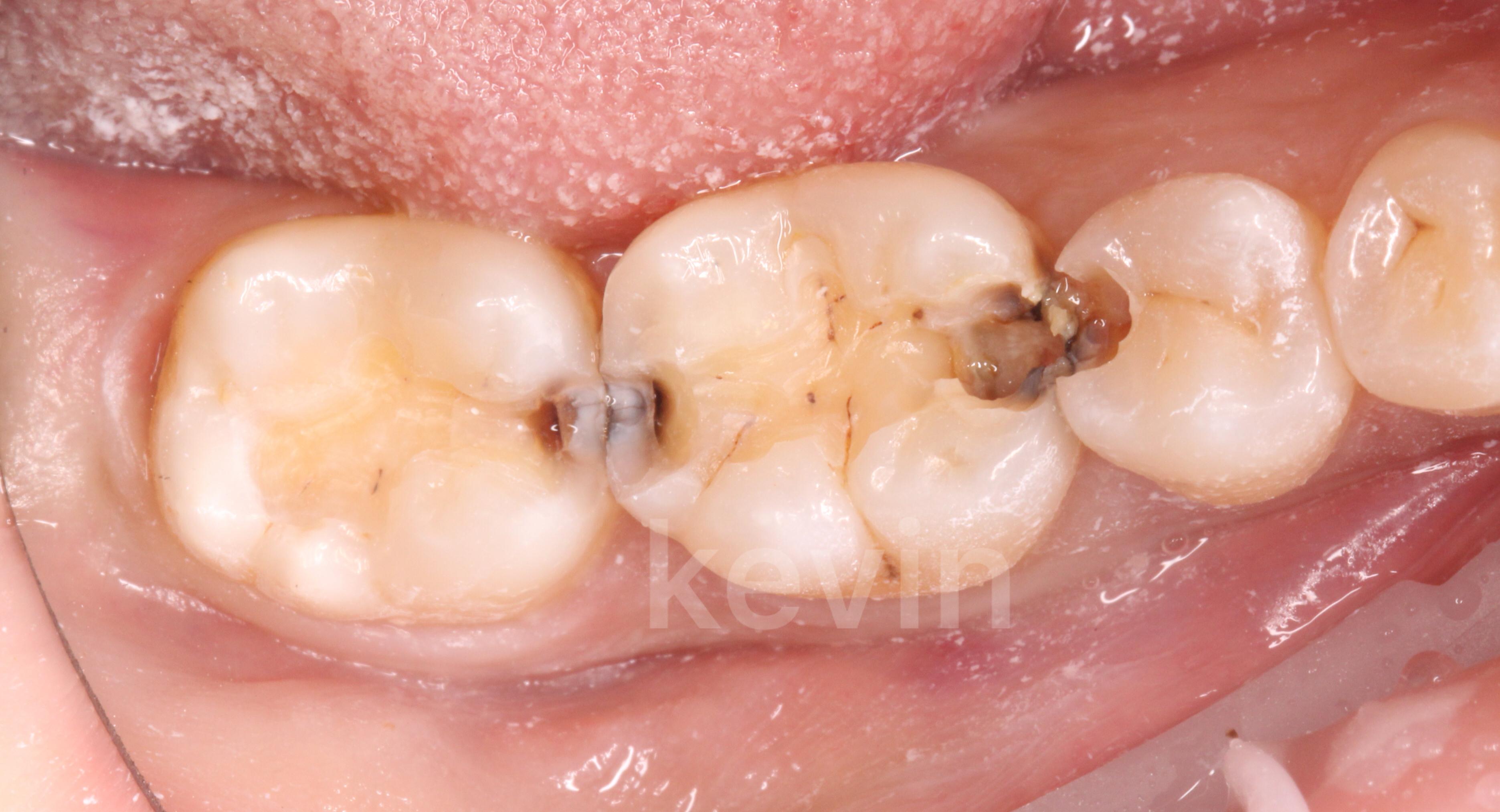 关于嵌体修复与传统补牙、全冠修复的对比 - 知乎