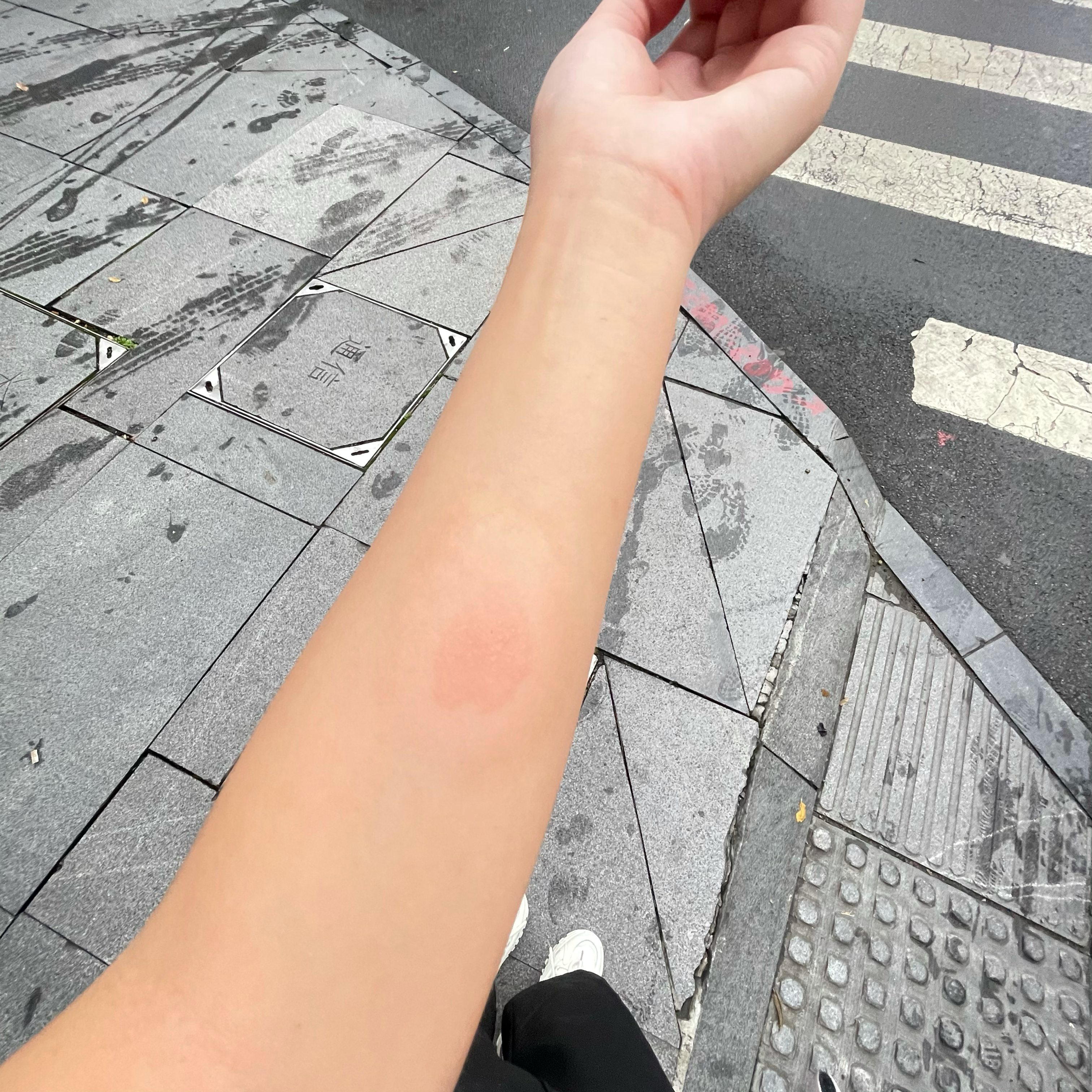 结核皮试起了个大水泡,破了怎么办? - 知乎