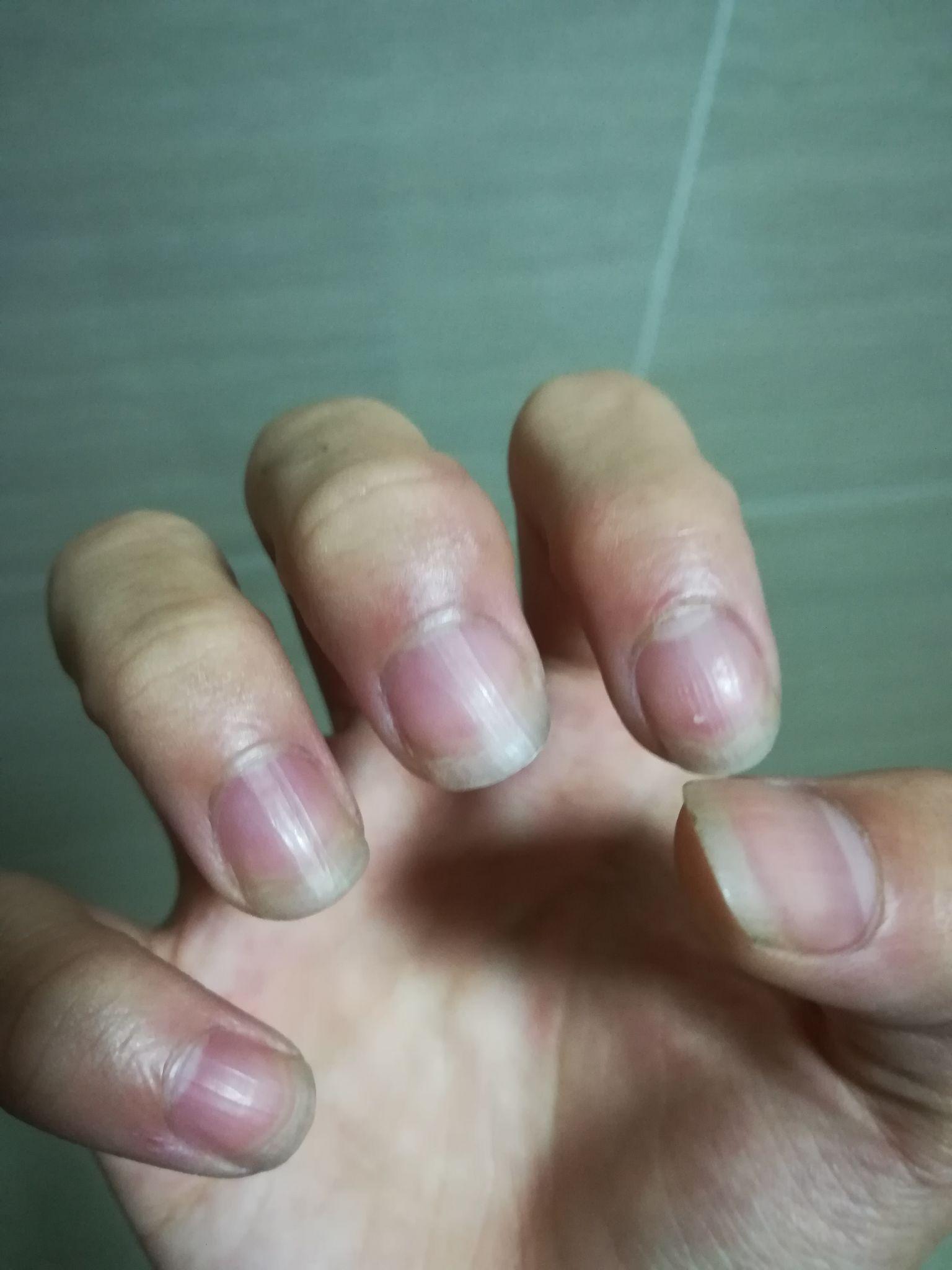 甲床过短应该如何变长? - 知乎