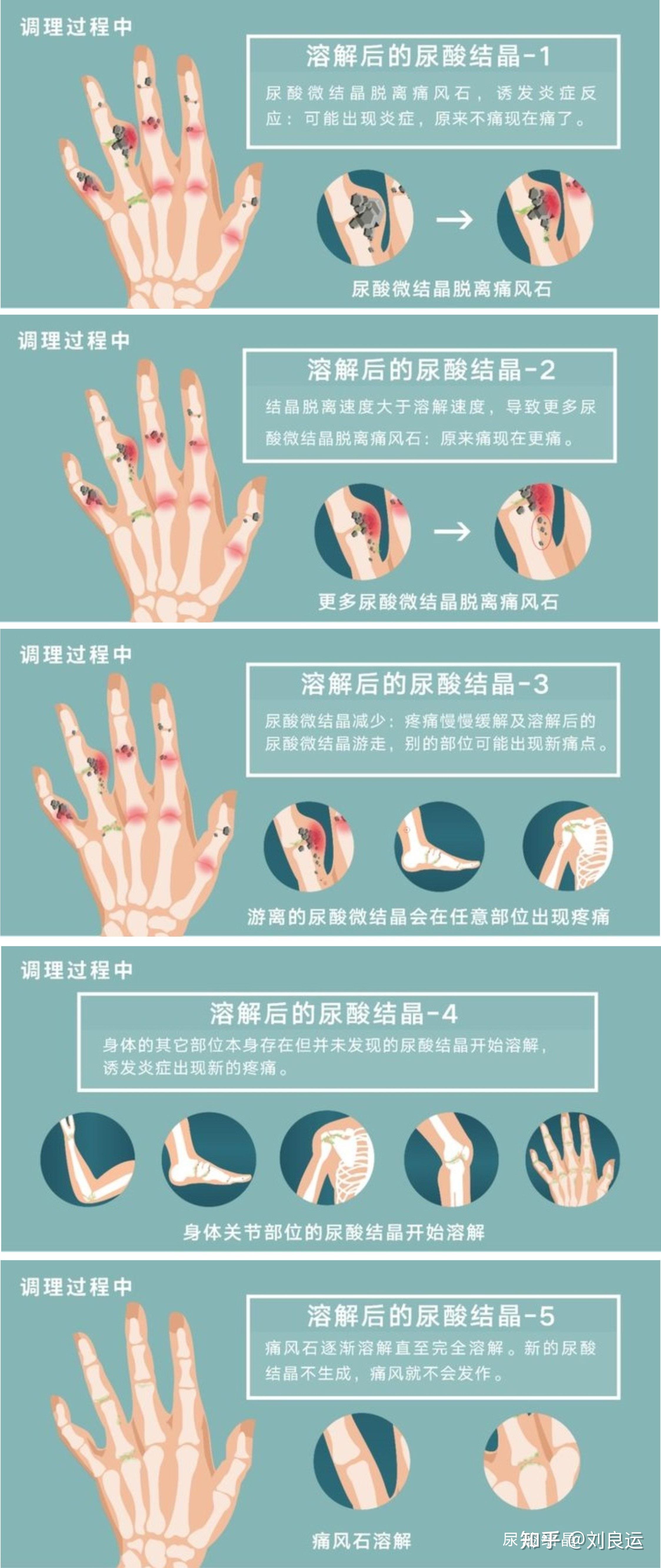 降尿酸调理过程中溶晶痛的作用原理有些痛风患者因为对溶晶痛不了解