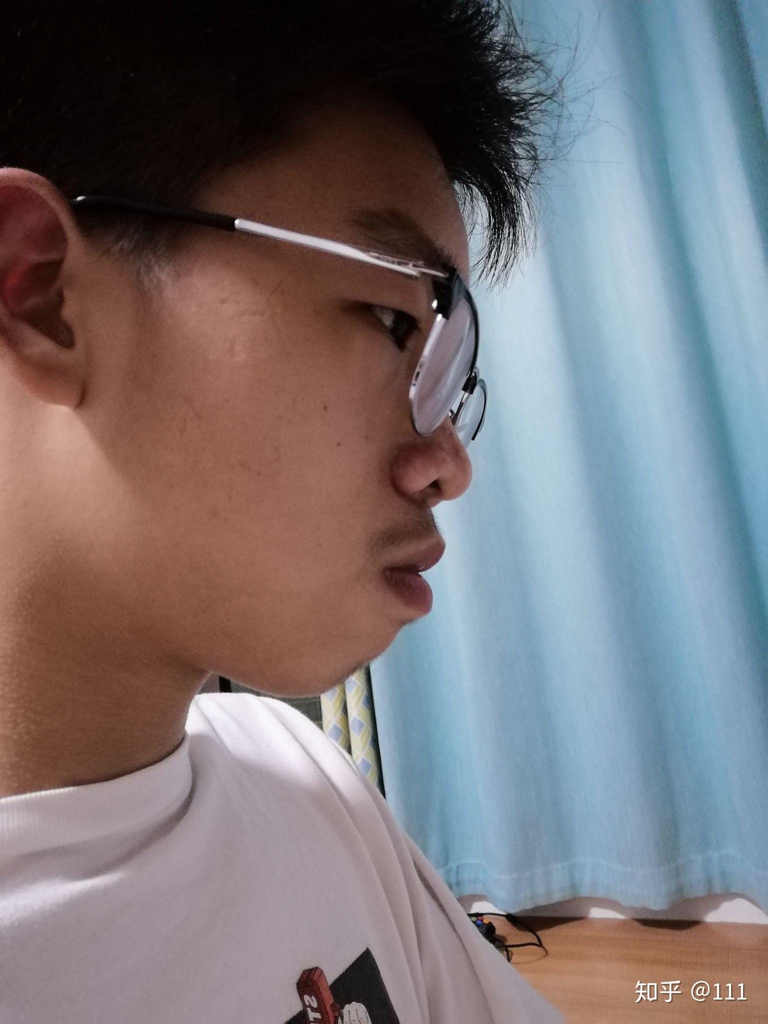 嘴巴凸下巴后缩咋办呢17岁了