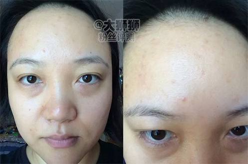 粉丝亲测记录皮肤辟谷5天后最终结果是