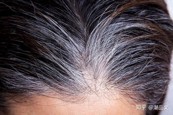 《科普》几岁长白发才算正常呢?不同年龄段长白发的原因! - 知乎