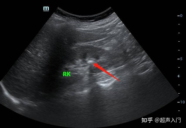 肾结石彩超图图片