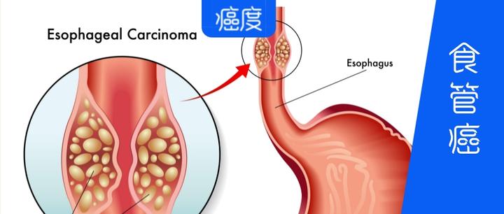 巨大食管癌患者，如何争取到治愈性手术机会？ 知乎