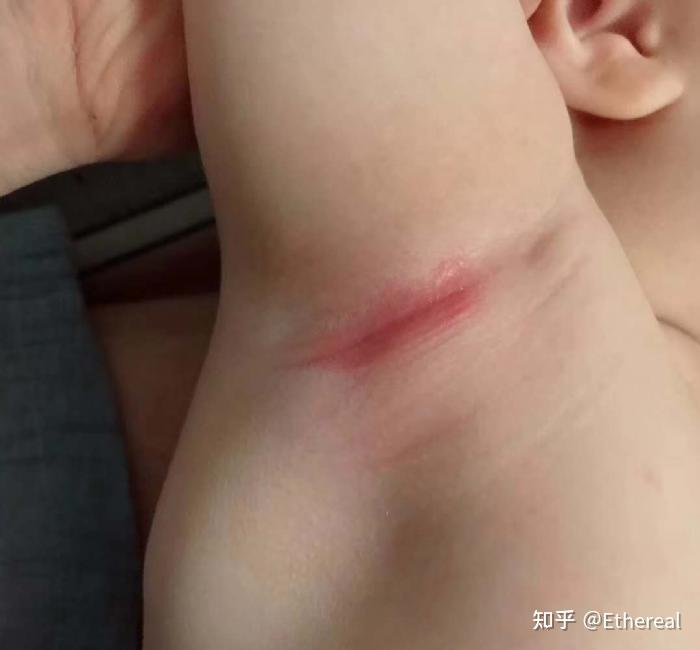 很多初生宝宝,由于皮肤细腻,会在屁屁,腋下,耳后,脖子处出现皮肤泛红