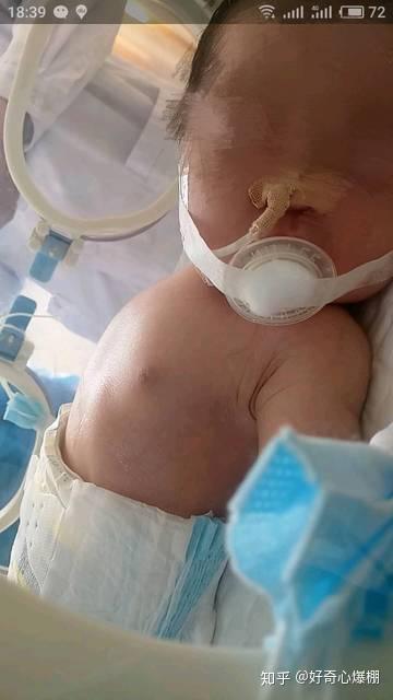 新生儿肠闭锁现已好 日常记录分享 知乎