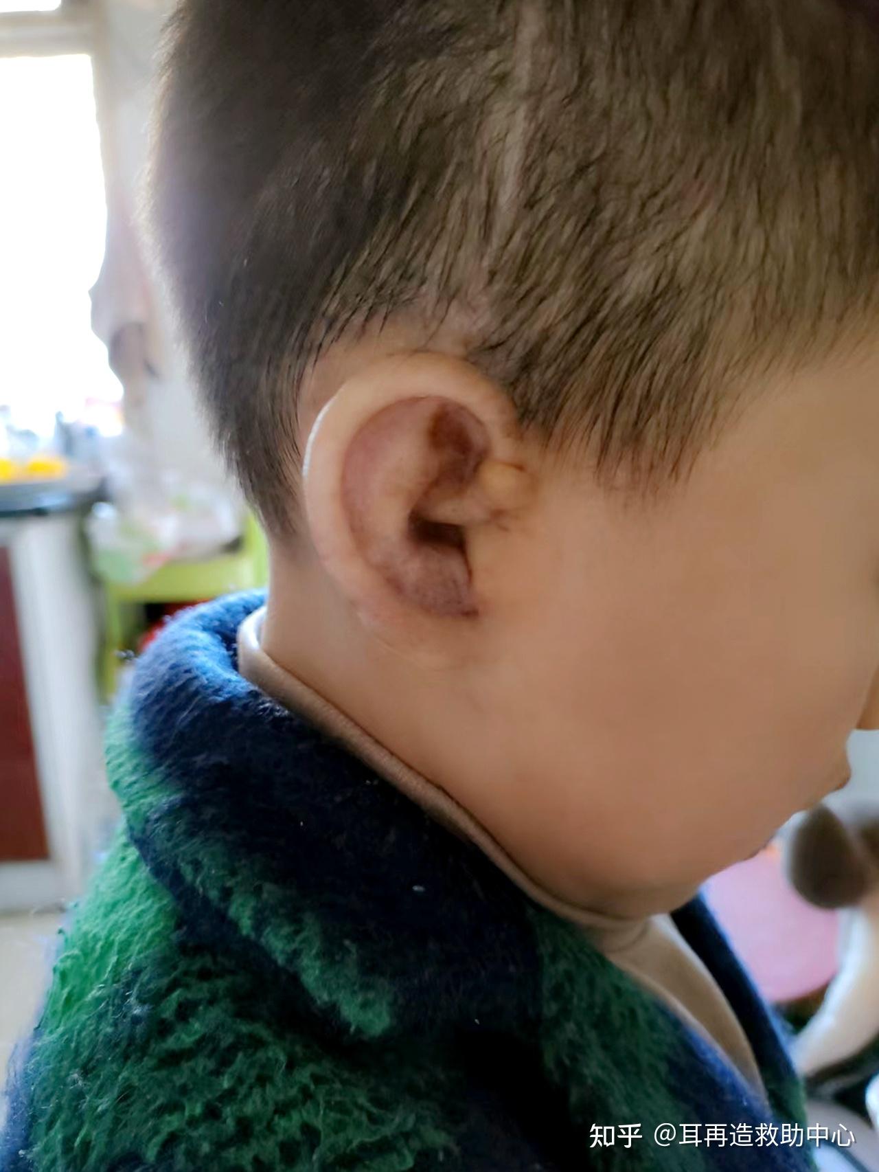 小耳畸形的尴尬：6岁就可以带孩子来手术了-康春雨-爱问医生