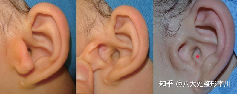 【小耳畸形诊疗指南01】先天性附耳屏-多耳畸形如何治疗？ - 知乎