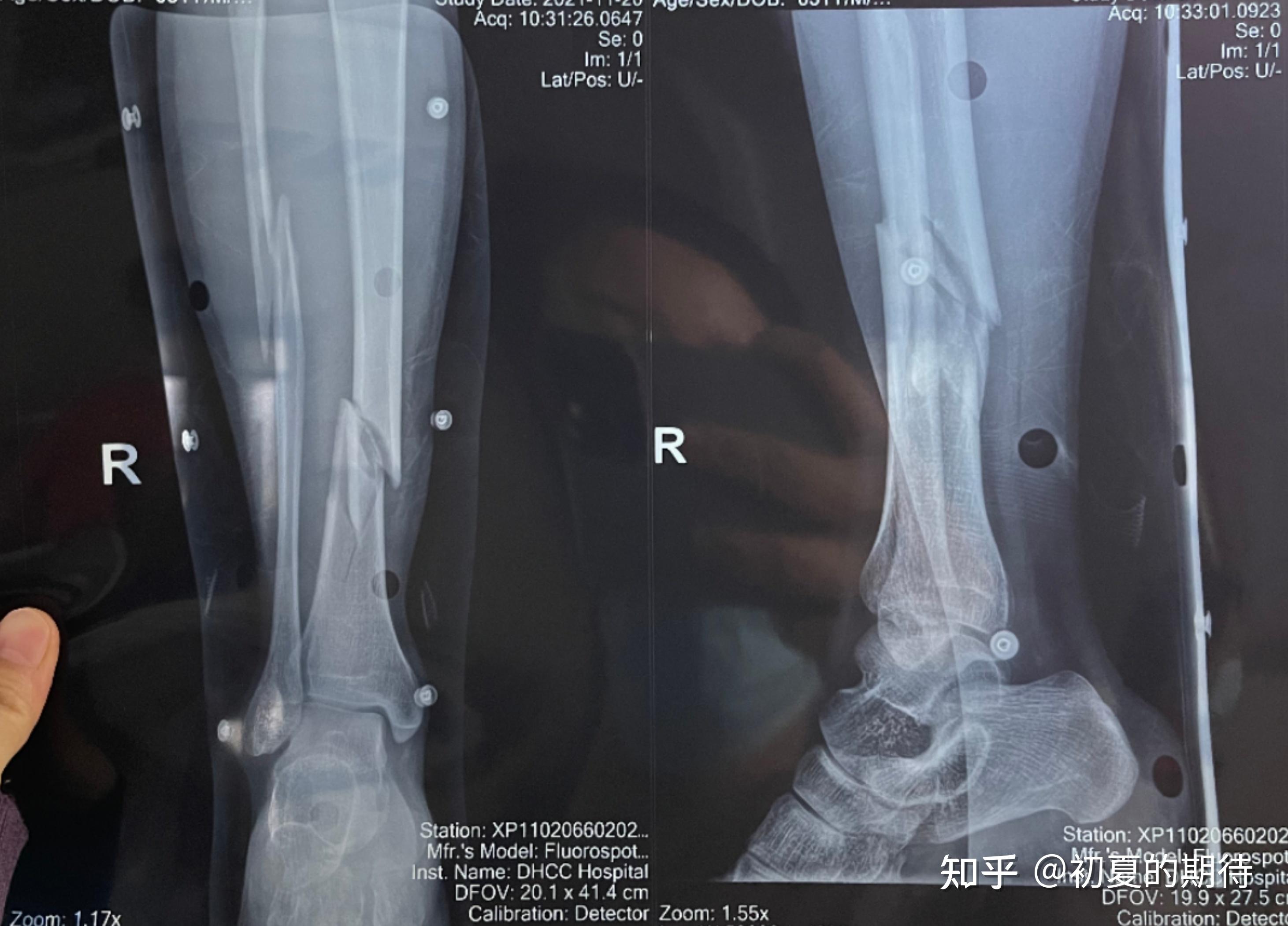 右小腿胫腓骨骨折康复过程(2022年05月08日更新) 