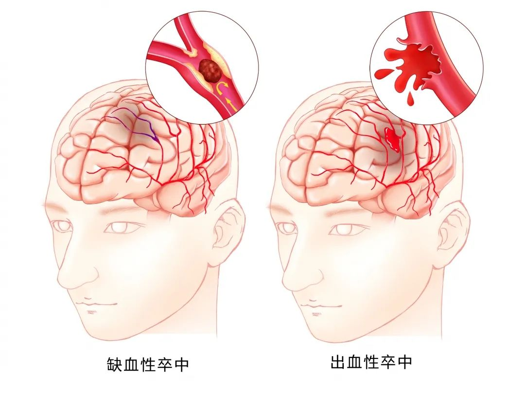 脑干出血原因图片