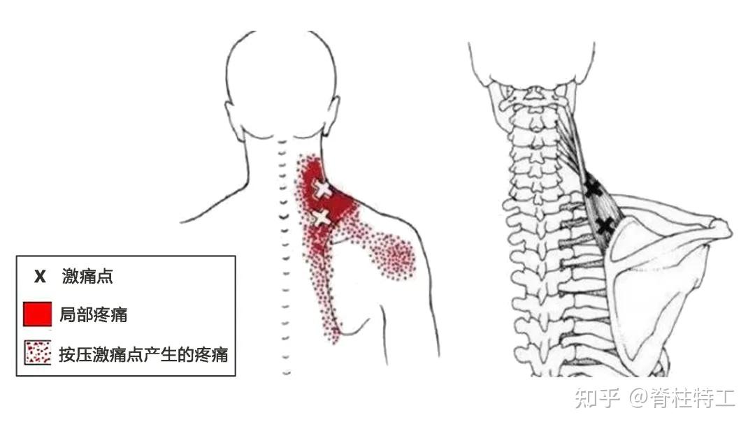 肩胛提肌疼痛图片