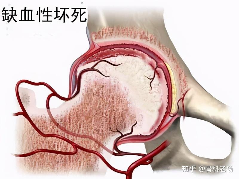 但是如果髋关节内部的积液过多,比如造成了髋关节内部压力过高的话