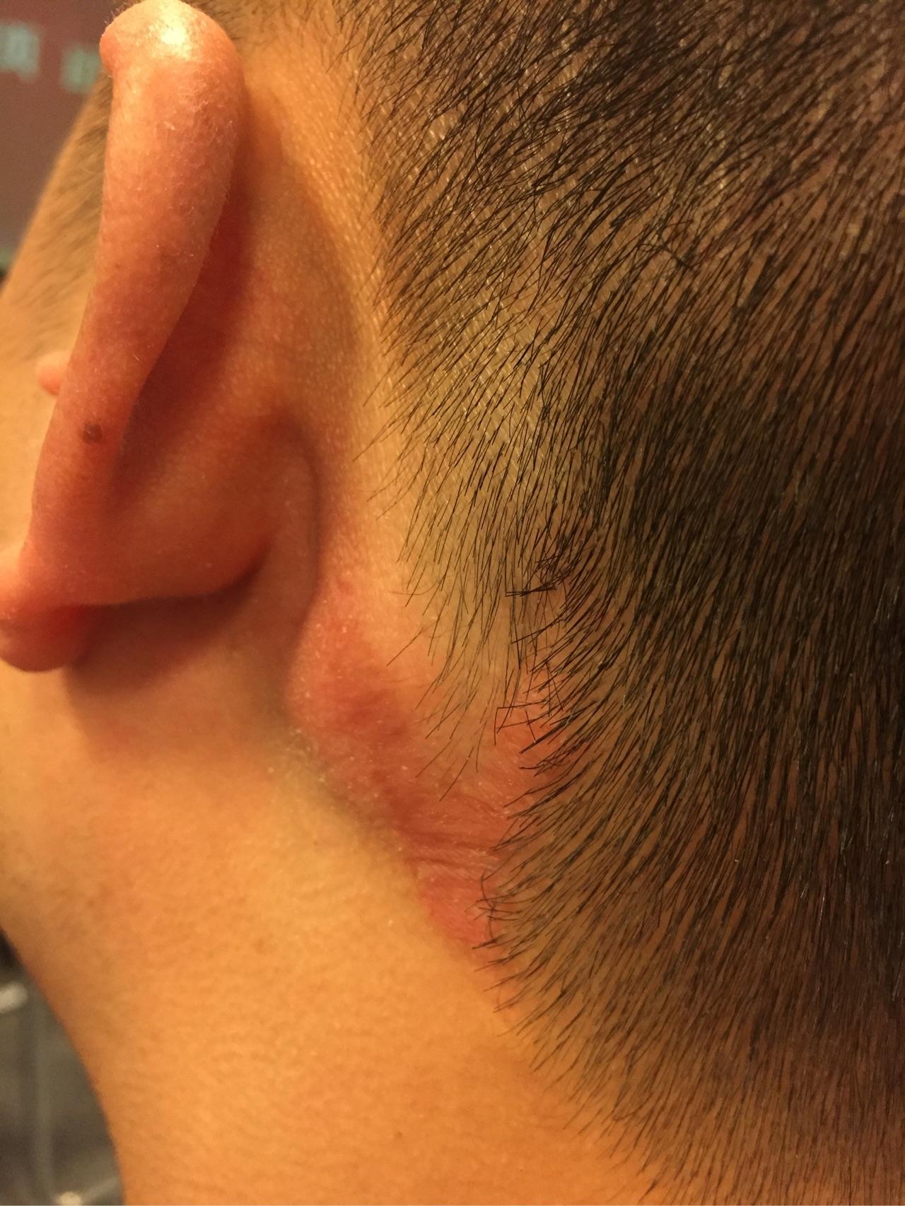 皮脂腺痣有什么好的治疗方案