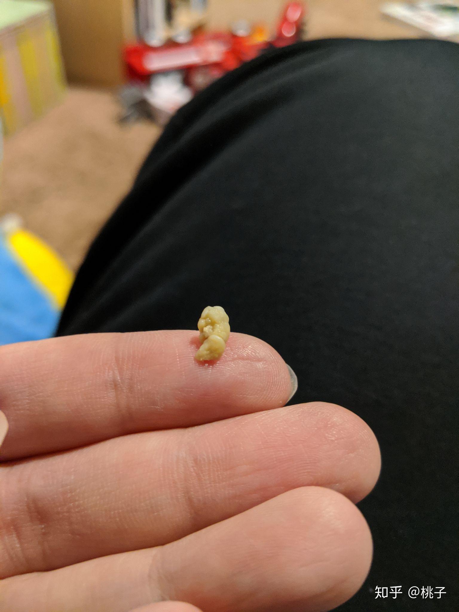 你见过最大的扁桃体结石有多大