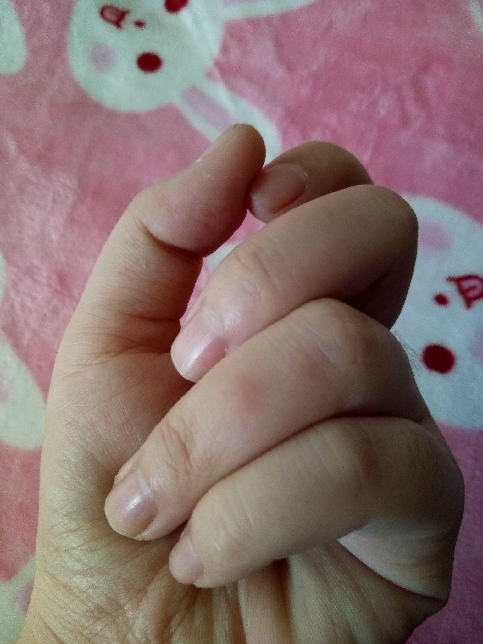 被蟑螂咬是一种什么体验