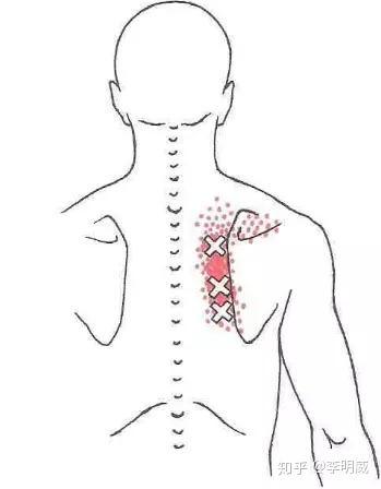 左后背痛位置图片图片